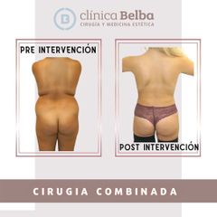 Liposucción - Clinica Belba