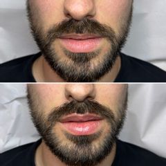 Aumento labios - Dr. Flecha