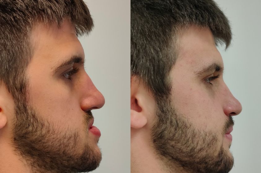 Cirugía maxilofacial antes y después - 820219