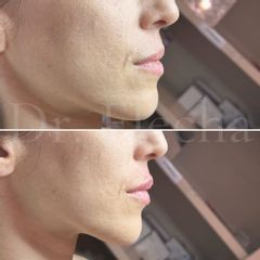 Aumento de labios - Dr. Flecha