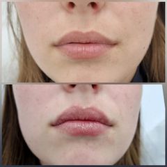 Aumento de labios - Clar&estetic