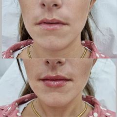 Aumento de labios - Clar&estetic