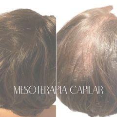 Mesoterapia capilar - Clinica Le Bloom