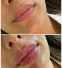 Aumento de labios - Clinica Le Bloom