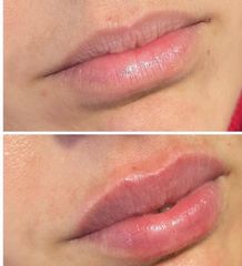 Aumento de labios - Clinica Le Bloom