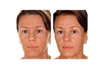 Antes y después Rejuvenecimiento facial