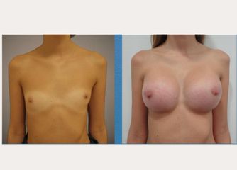 Antes y después Aumento de pechos