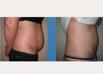 Antes y después Abdominoplastia