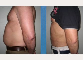 Antes y después Abdominoplastia hombre