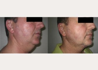 Antes y después Liposucción de cuello