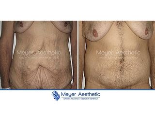 Antes y después abdominoplastia