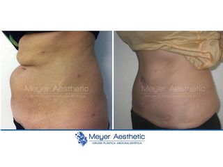 Antes y después abdominoplastia