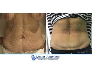 Antes y después abdominoplastia