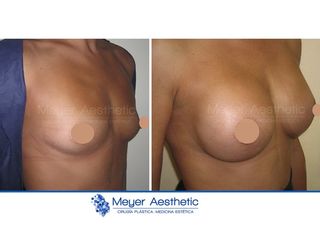 Antes y después Aumento de pecho