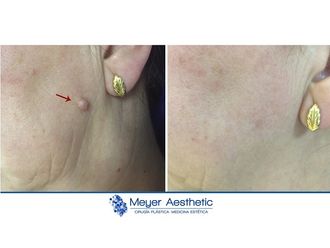 Verrugas - 608042