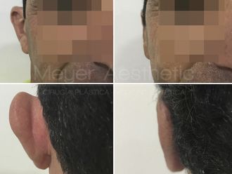 Otoplastia - 628269