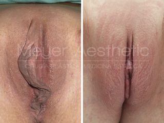 Antes y después Labioplastia