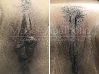 Antes y después Labioplastia de Labios Menores