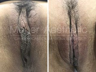 Antes y después Labioplastia