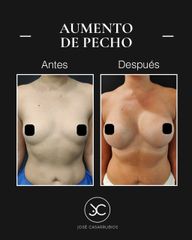 Aumento de pecho - Dr. Jose Casarrubios