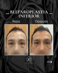 Blefaroplastia - Dr. Jose Casarrubios