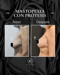 Mastopexia - Dr. Jose Casarrubios
