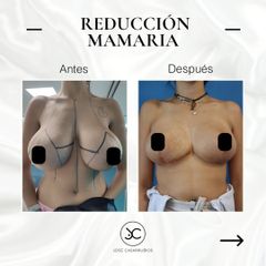 Reducción senos - Dr. Jose Casarrubios
