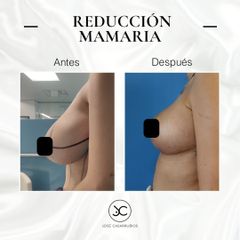 Reducción senos - Dr. Jose Casarrubios
