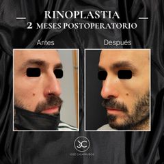 Rinoplastia - Dr. Jose Casarrubios