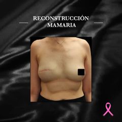 Reconstrucción mamaria - Dr. Jose Casarrubios