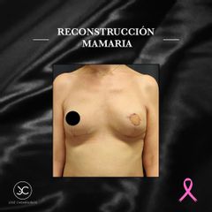 Reconstrucción mamaria - Dr. Jose Casarrubios