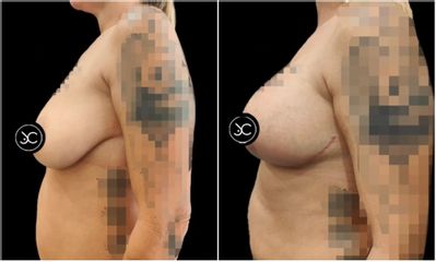 Mastopexia - Dr. Jose Casarrubios