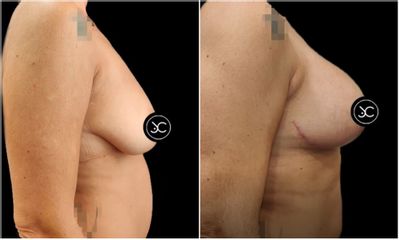 Mastopexia - Dr. Jose Casarrubios