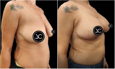 Mastopexia - Dr. Jose Casarrubios