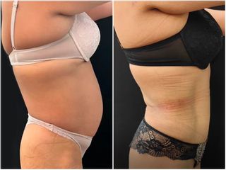Abdominoplastia - Dr. Jose Casarrubios