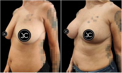 Mastopexia - Dr. Jose Casarrubios
