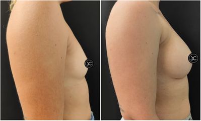 Aumento de pecho - Dr. Jose Casarrubios