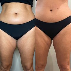 Criolipólisis en cara interna muslo - Hakari Clinics