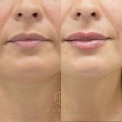 Aumento labios - Hakari Clinics