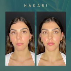 Ácido Hialurónico - Hakari Clinics