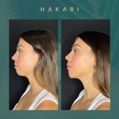 Ácido hialurónico - Hakari Clinics