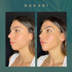 Ácido hialurónico - Hakari Clinics