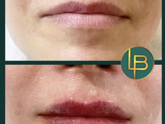 Aumento labios antes y después - 872931