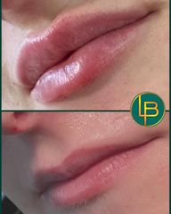 Clínica Dra. Leila Bidaki - Aumento de labios