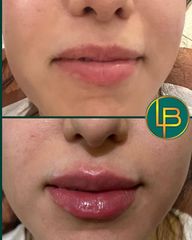 Clínica Dra. Leila Bidaki - Aumento de labios