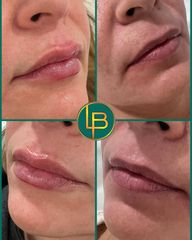 Clínica Dra. Leila Bidaki - Aumento de labios