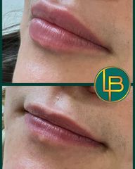 Clínica Dra. Leila Bidaki - Aumento de labios