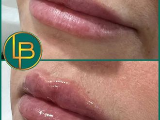 Aumento labios antes y después - 875634