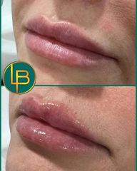 Clínica Dra. Leila Bidaki - Aumento de labios