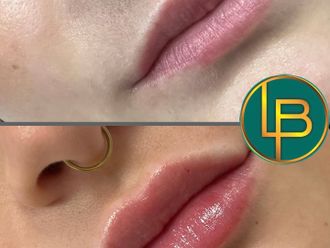 Aumento labios antes y después - 875635